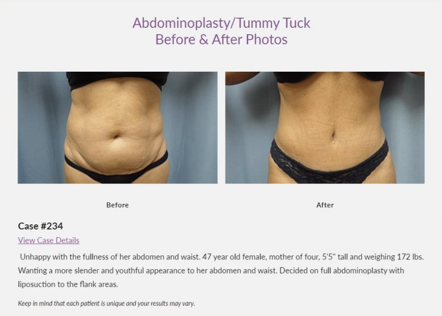 Gaining Weight After a Tummy Tuck: What Roswell & Atlanta Patients Need to  Know